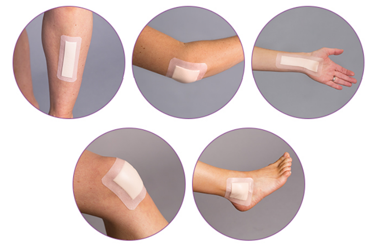 Illustrative example of foaming dressing