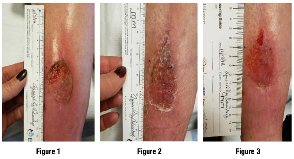 Illustrative example of silver alginate dressing